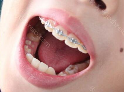 隐形义齿图片什么样呢？和种植牙齿相比哪种更好一些呢？