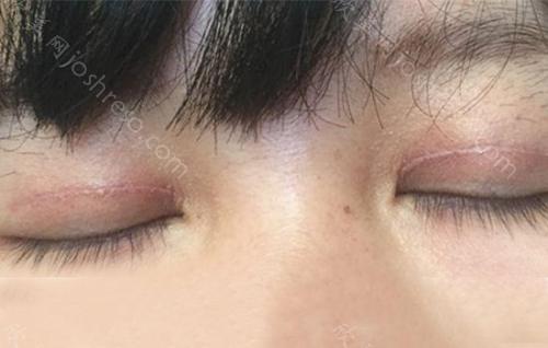 双眼皮疤痕可以激光吗