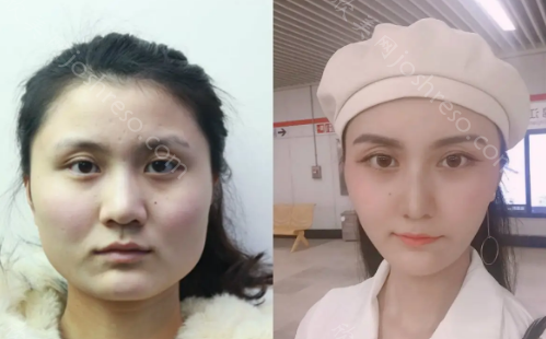 [崔荣达]上海首尔丽格崔荣达磨骨案例评价是真的吗?