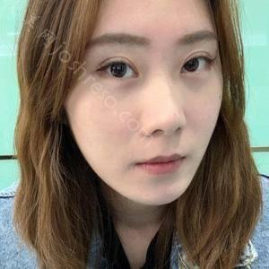 韩式小切口双眼皮是永久的吗