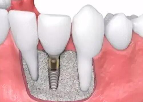 镶牙和种牙有什么区别哪个好呢？看看优点和缺点都是什么呢？