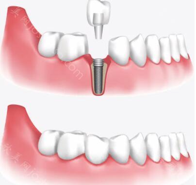 镶牙和种牙有什么区别哪个好呢？看看优点和缺点都是什么呢？