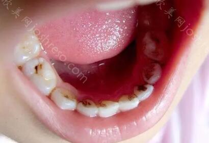 牙齿黑缝隙如何改善呢？牙齿黑缝隙的原因是什么呢？