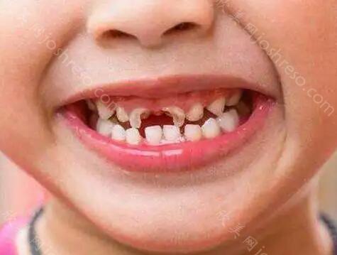 牙齿黑缝隙如何改善呢？牙齿黑缝隙的原因是什么呢？