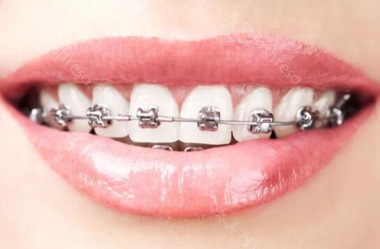 矫正牙齿隐形牙套费用多少呢？矫正牙齿可能会带来哪些危害呢？