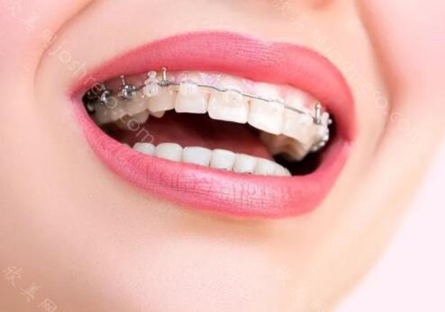 牙博士牙齿矫正如何呢？收费贵不贵呢？详情分享下！