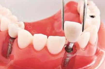 种植牙是否成功一个月就知道呢？种植牙齿之后如何保护呢？