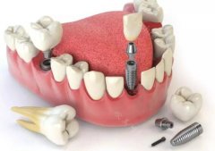 牙齿修复的几种方法和价格多少呢？牙齿修复如何选择合适的医