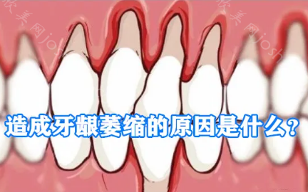 牙龈萎缩太可怕了！看完正常的牙龈和萎缩图片对比你还能保持淡定吗？