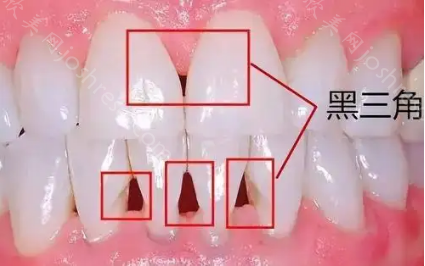 牙龈萎缩太可怕了！看完正常的牙龈和萎缩图片对比你还能保持淡定吗？