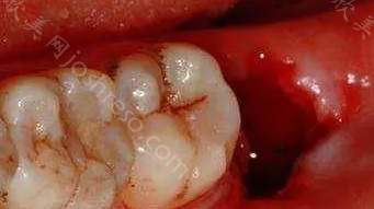 拔牙牙洞恢复过程图解，拔牙后如何护理?