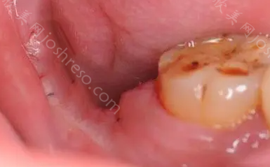 拔牙牙洞恢复过程图解，拔牙后如何护理?