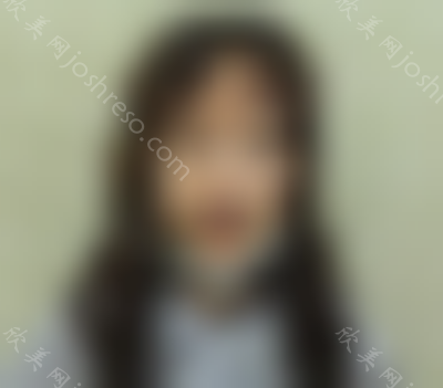 合肥恒美廖亚敏隆鼻好吗?价格表-术前术后图