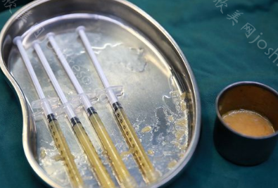 抽出来10斤脂肪的图片价位，可以吸脂的部位有哪些?