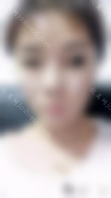 杭州静丽医疗美容诊所逯联合自体脂肪填充全脸好不好_术后154天手术效果