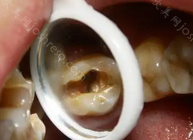 牙髓炎拖几个月会恶化吗?出现牙髓炎怎么办?