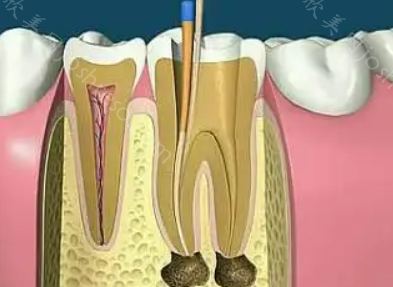 牙髓炎拖几个月会恶化吗?出现牙髓炎怎么办?