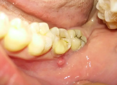 牙癌的早期症状是什么?附牙癌的图片、原因