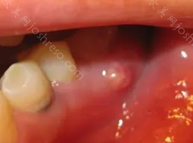 牙癌的早期症状是什么?附牙癌的图片、原因