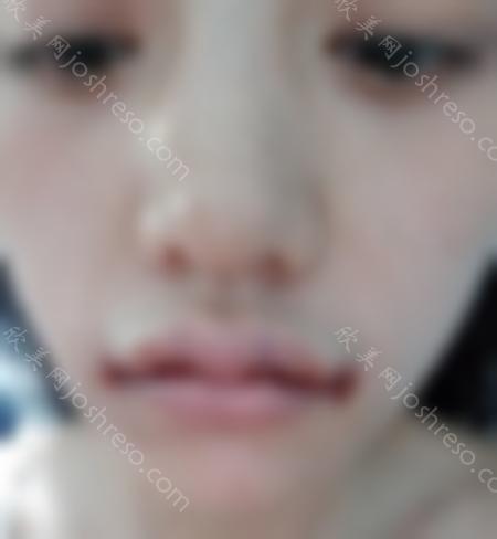 找杭州维多利亚整形医院的柳兆峰做的M唇+嘴角上扬手术后