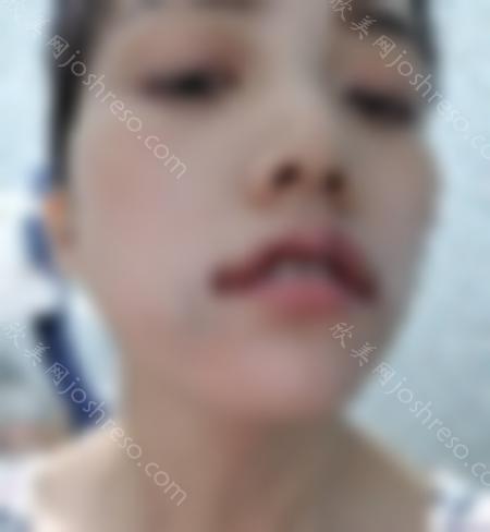 找杭州维多利亚整形医院的柳兆峰做的M唇+嘴角上扬手术后2天