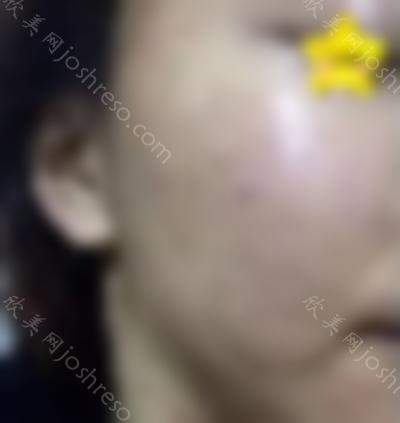 在广州市佳人医疗美容门诊部做点阵激光祛痘手术后10天