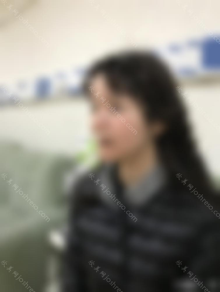 像素激光怎么样_像素激光术后164天前后照对比