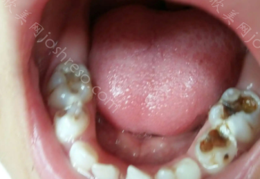 牙坏了一半烂掉了是拔还是补?牙齿坏掉一半是龋齿吗?