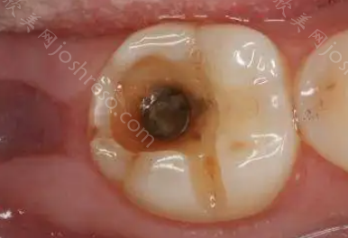 牙坏了一半烂掉了是拔还是补?牙齿坏掉一半是龋齿吗?