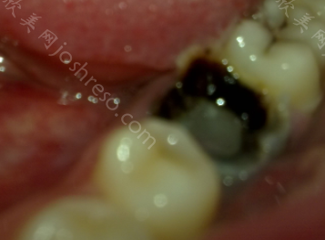 牙坏了一半烂掉了是拔还是补?牙齿坏掉一半是龋齿吗?