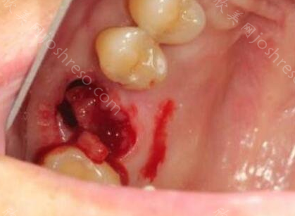 拔智齿洞恢复过程，拔智齿后需要注意哪些?附图解
