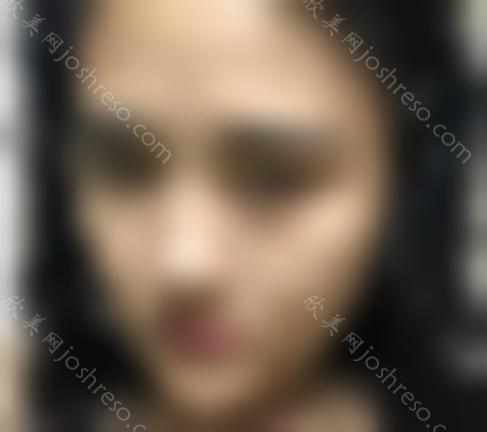 上海九院刘凯的鼻综合做得好吗?案例反馈-收费标准