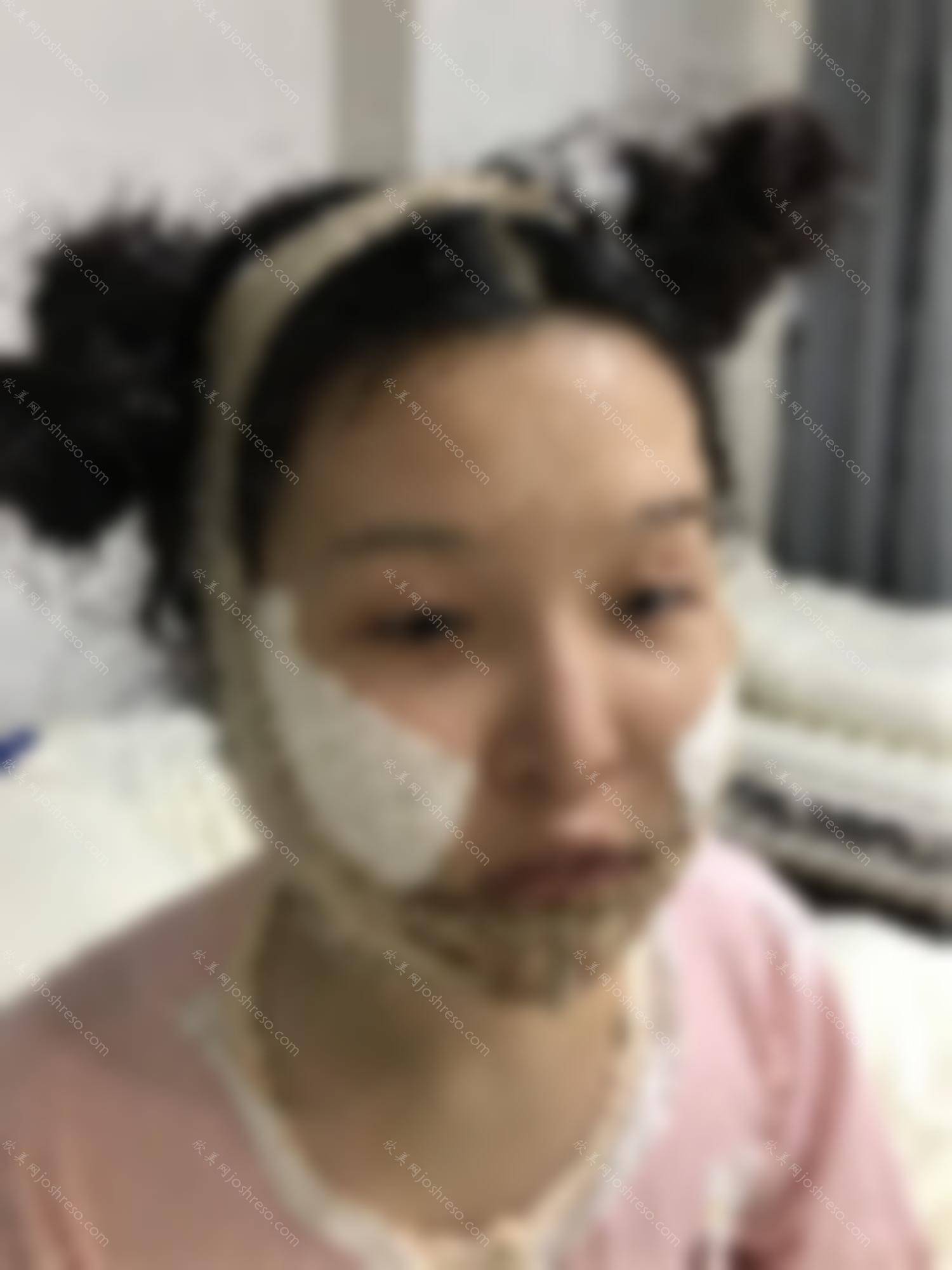 上海第九院下颌角磨骨恢复过程图 再也不是路人脸了