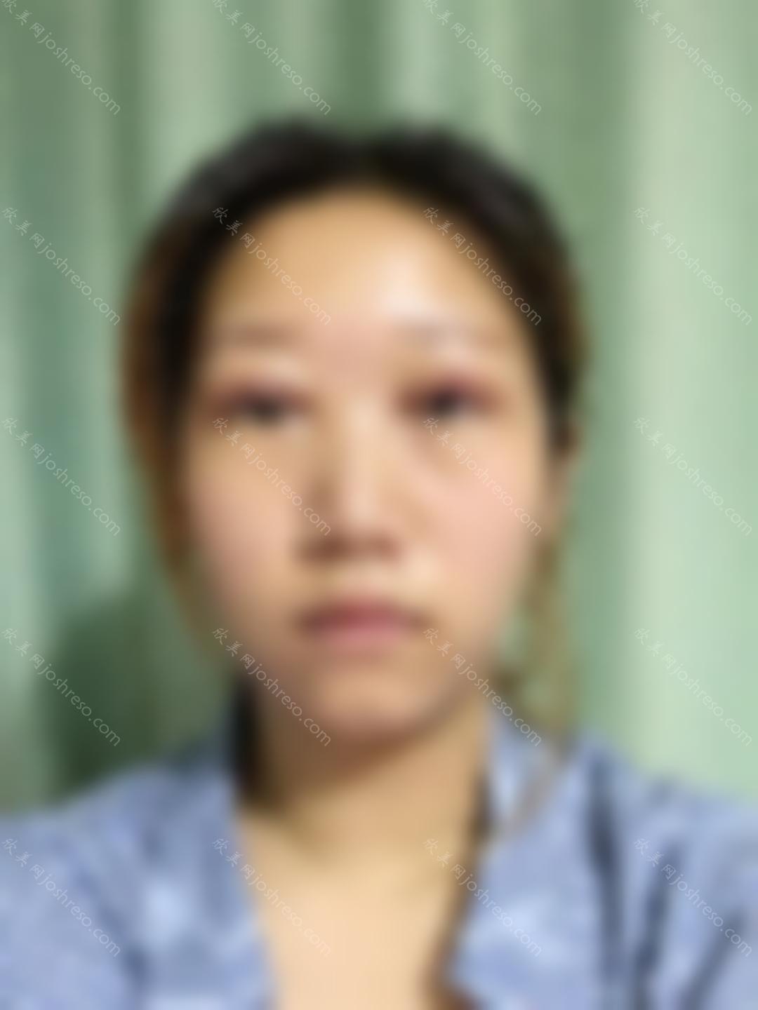 上海第九院眼部整形那个医生好?实力推荐李青峰，附上眼部整形价格表