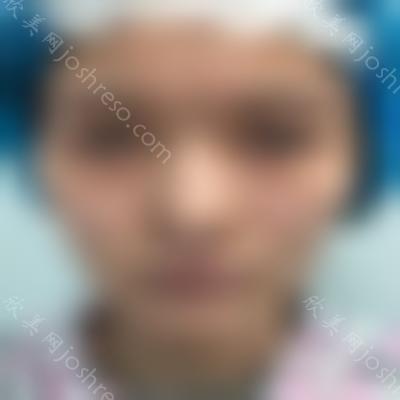 成都西区医院车红昌医生全切双眼皮案例?顾客反馈对比图