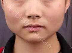 方脸整牙后脸型变化图，方形脸整牙有效果吗？