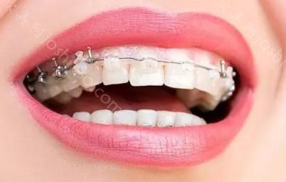 牙齿严重内倾斜图片，牙齿严重内倾斜原因和矫治方法介绍！