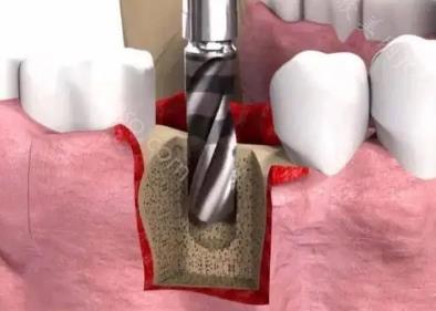 种牙的流程和方法，一篇文章带你了解种植牙是怎么做的？