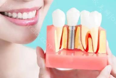 种牙的流程和方法，一篇文章带你了解种植牙是怎么做的？