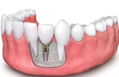 牙齿种植步骤和流程介绍，看文了解什么是种植牙全步骤！