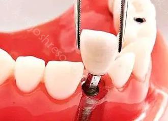 种植牙详细步骤图解，种植牙是怎么做的你知道吗？