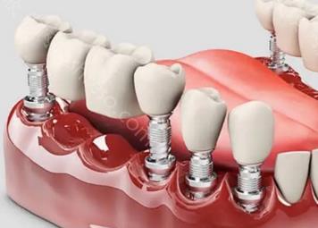 六十岁老人种牙好还是镶牙好？选择正确的牙齿修补方式给口腔更多健康！