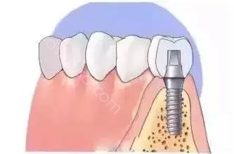 口腔医院种植牙价格表？影响牙齿种植价格因素都有哪些？