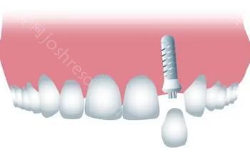 口腔医院种植牙价格表？影响牙齿种植价格因素都有哪些？
