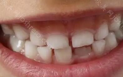 牙齿内倾还是垂直好看？牙齿内倾斜有办法改善吗？