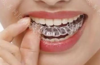 哪个牙齿矫正好方法？牙齿矫正应该选择哪种方式？
