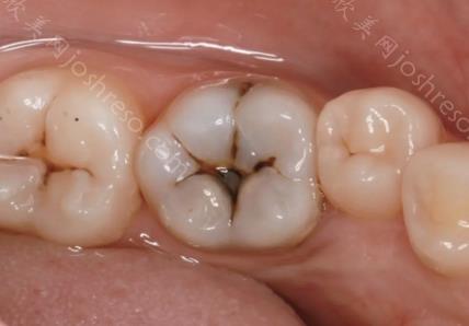 补牙3m树脂z350与z250哪个好？补牙前后注意事项有哪些？
