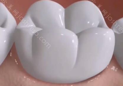 种植牙的过程步骤视频，带你了解种植牙的手术全过程！