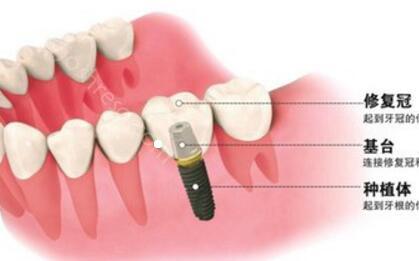 种植牙的种牙过程是什么，一文带你了解种植牙全过程！