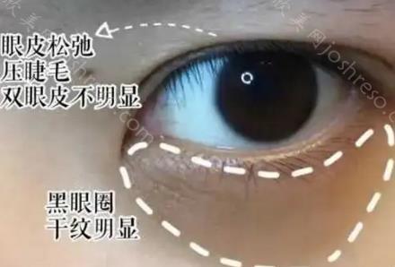 美国赛诺秀c6做黑眼圈上眼皮可以不？美国赛诺秀c6都有哪些功效？